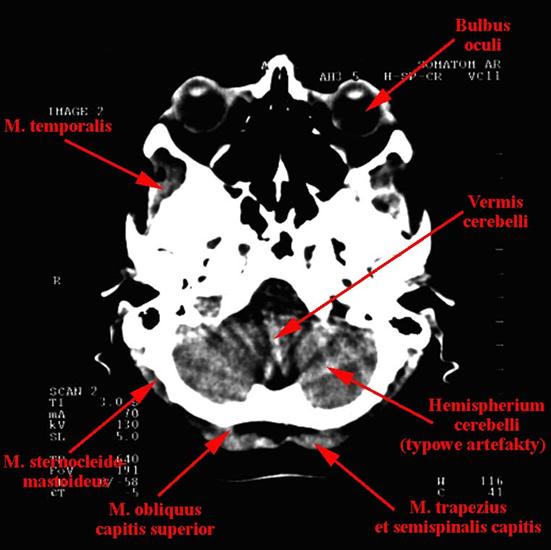 tomografia komputerowa głowy - 01c.jpg